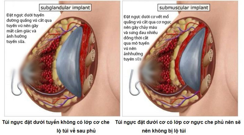 Nâng ngực mổ hở quầng vú