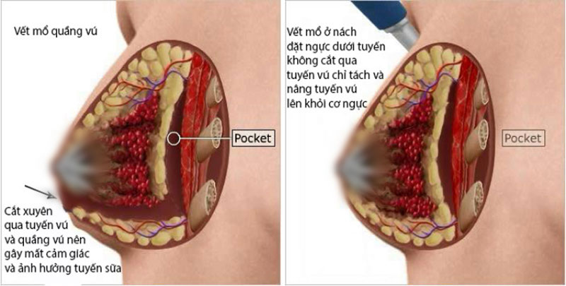 Nâng ngực mổ hở quầng vú